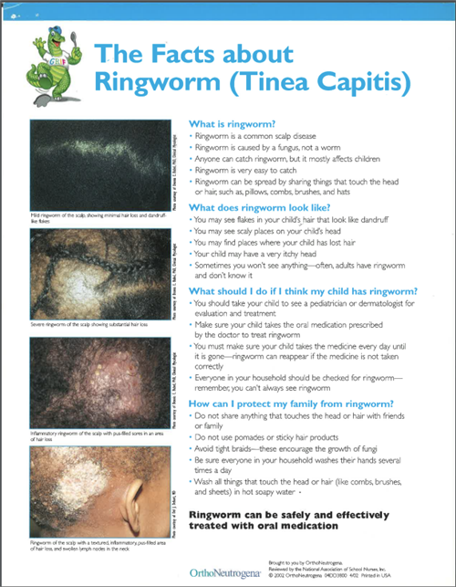 Ring worm